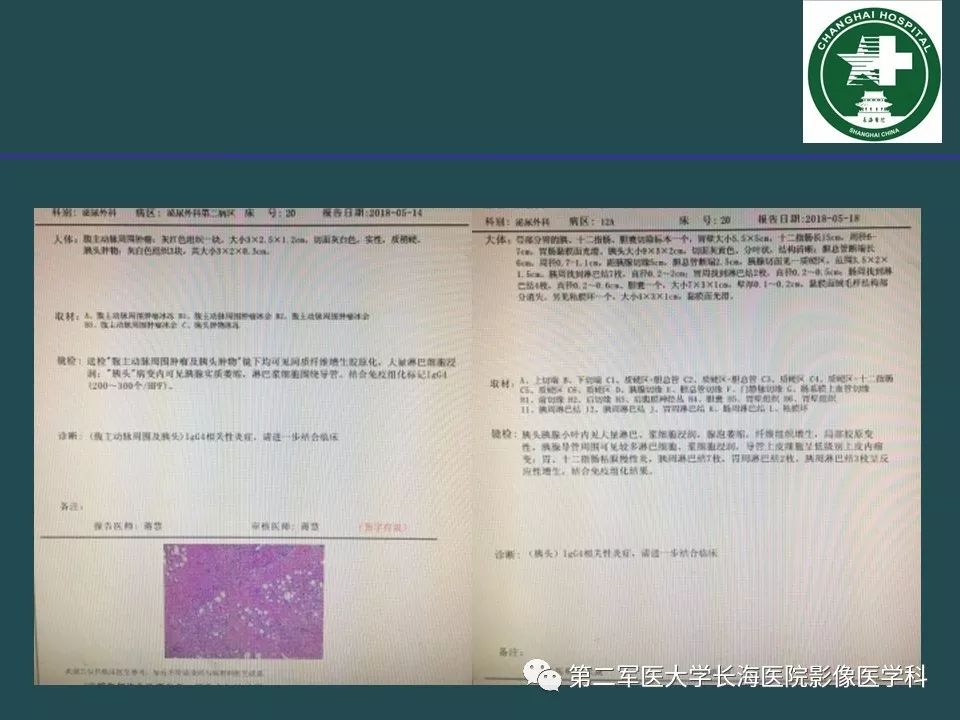 影像PPT - 【PPT】常见的腹膜后占位诊断及鉴别诊断-44