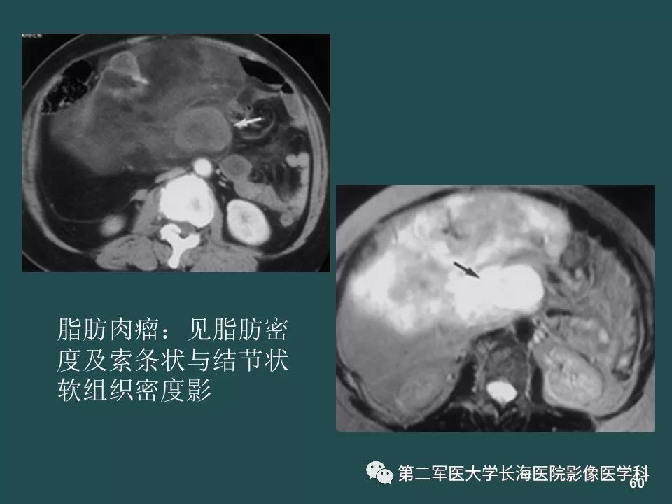 影像PPT - 【PPT】常见的腹膜后占位诊断及鉴别诊断-59