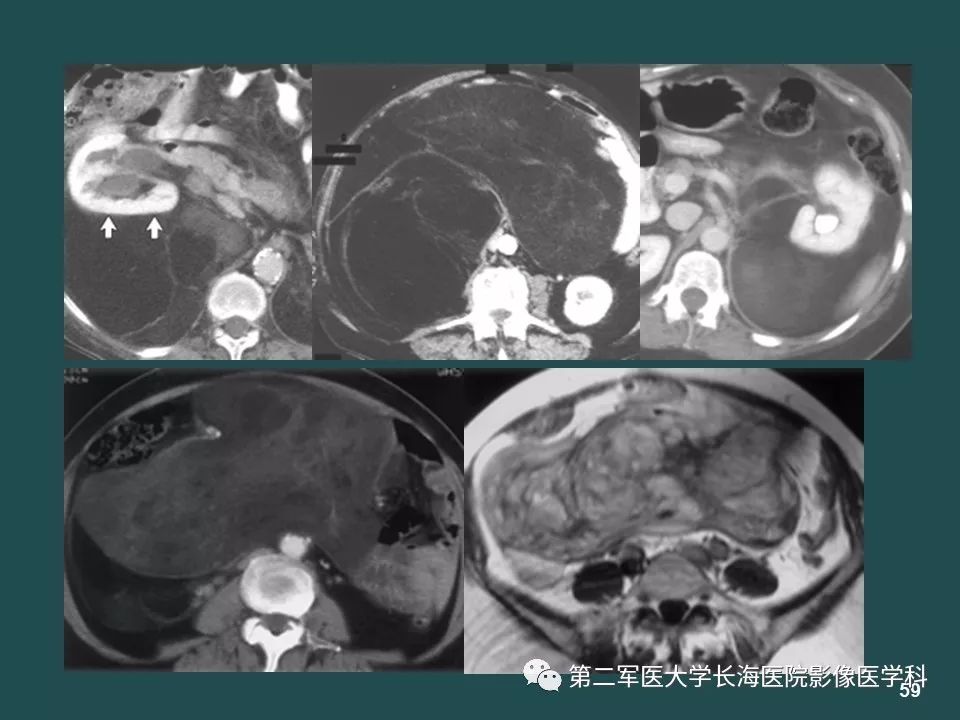 影像PPT - 【PPT】常见的腹膜后占位诊断及鉴别诊断-58