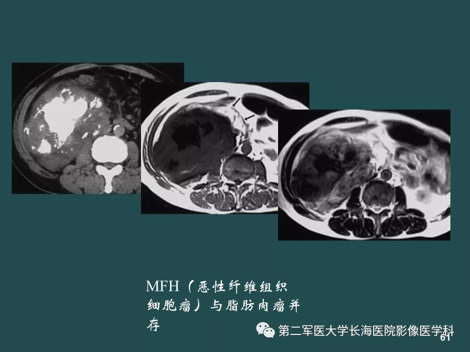 影像PPT - 【PPT】常见的腹膜后占位诊断及鉴别诊断-60