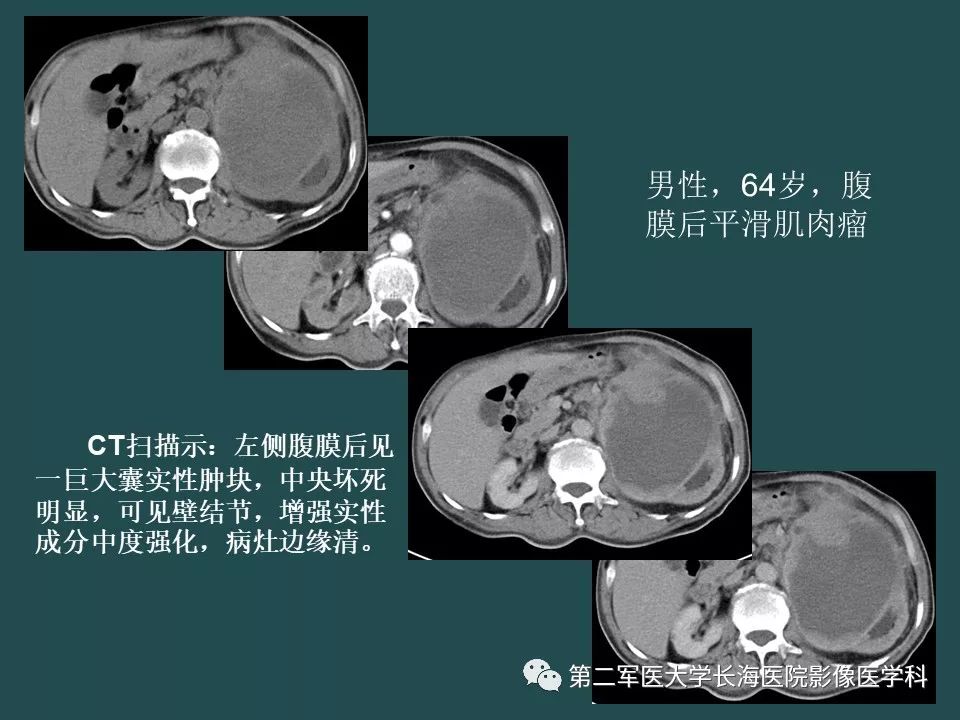 影像PPT - 【PPT】常见的腹膜后占位诊断及鉴别诊断-62