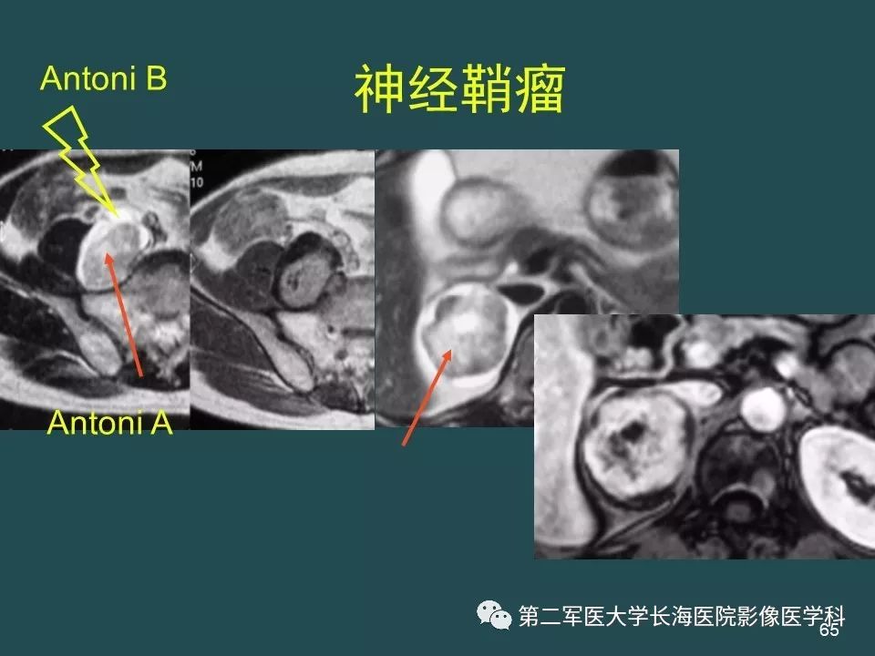 影像PPT - 【PPT】常见的腹膜后占位诊断及鉴别诊断-64