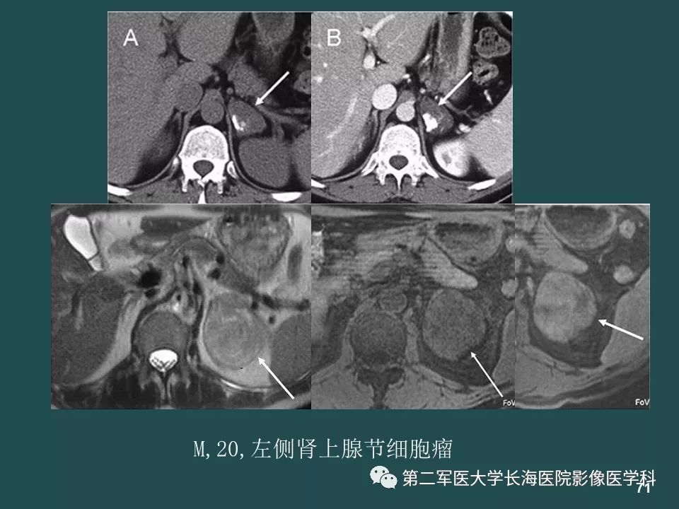 影像PPT - 【PPT】常见的腹膜后占位诊断及鉴别诊断-70