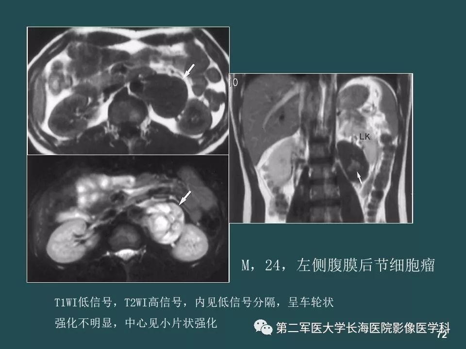 影像PPT - 【PPT】常见的腹膜后占位诊断及鉴别诊断-71