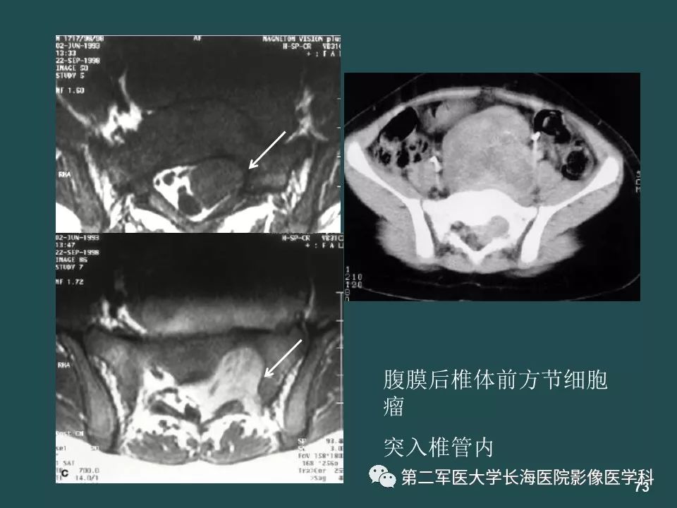影像PPT - 【PPT】常见的腹膜后占位诊断及鉴别诊断-72