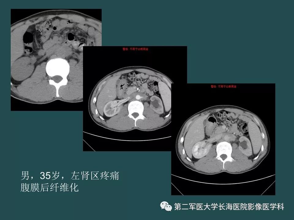 影像PPT - 【PPT】常见的腹膜后占位诊断及鉴别诊断-79