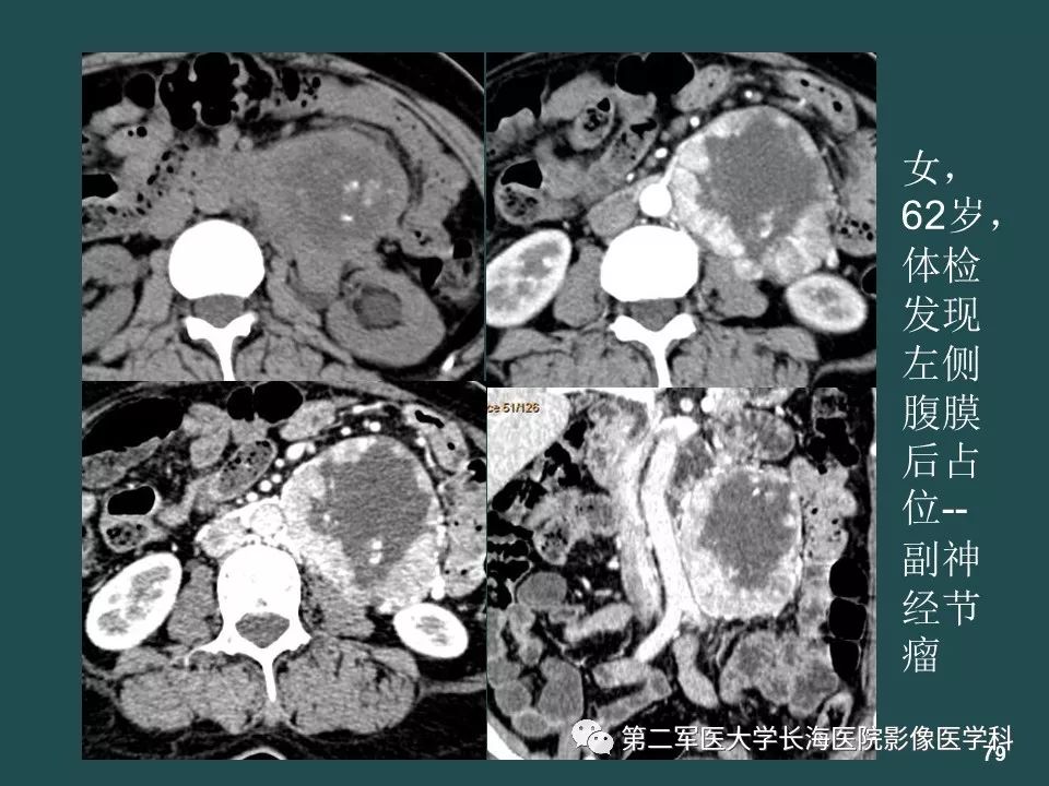 影像PPT - 【PPT】常见的腹膜后占位诊断及鉴别诊断-78