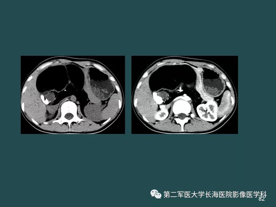 影像PPT - 【PPT】常见的腹膜后占位诊断及鉴别诊断-81