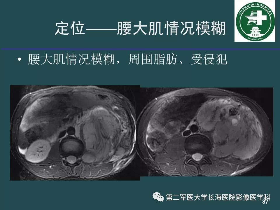 影像PPT - 【PPT】常见的腹膜后占位诊断及鉴别诊断-86