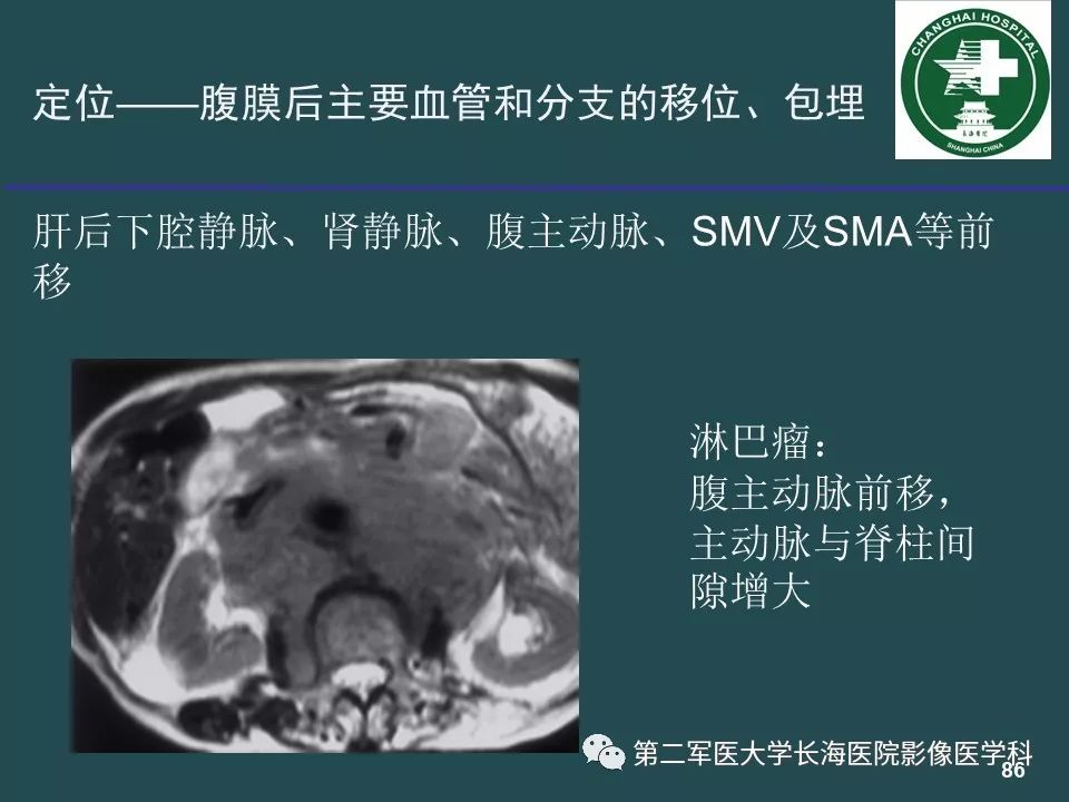 影像PPT - 【PPT】常见的腹膜后占位诊断及鉴别诊断-85