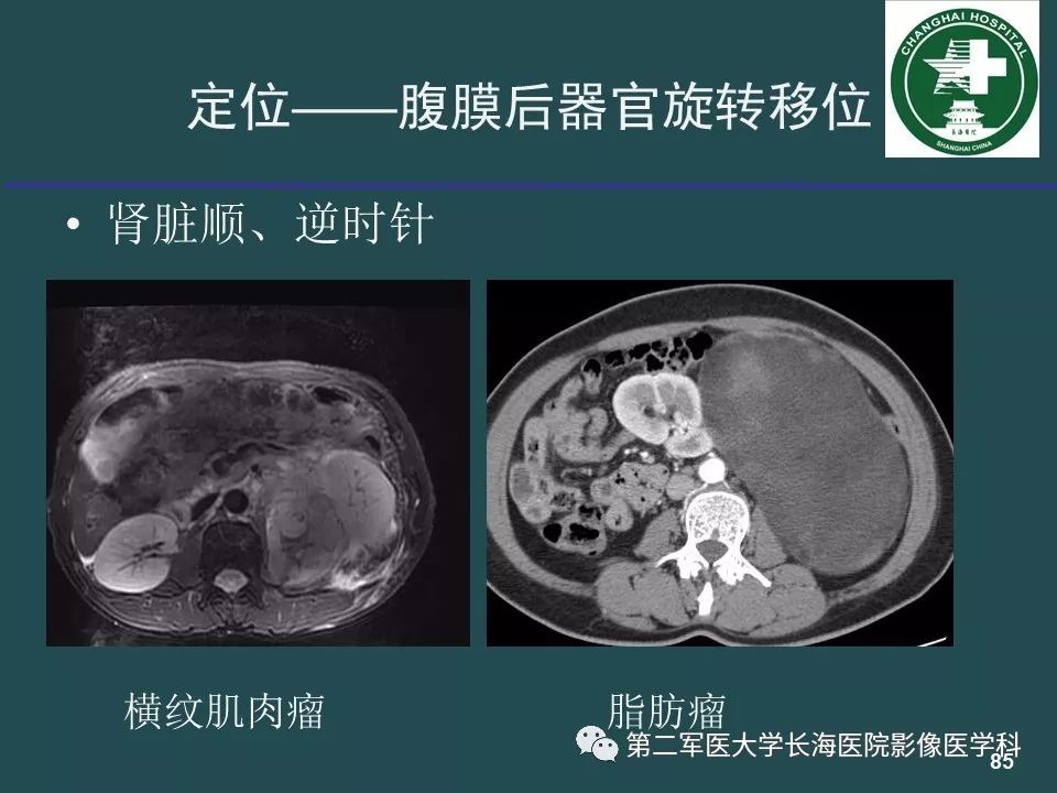 影像PPT - 【PPT】常见的腹膜后占位诊断及鉴别诊断-84