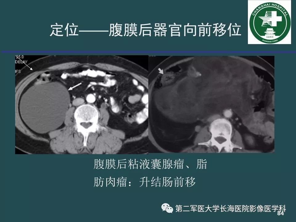 影像PPT - 【PPT】常见的腹膜后占位诊断及鉴别诊断-83