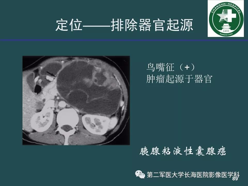 影像PPT - 【PPT】常见的腹膜后占位诊断及鉴别诊断-88