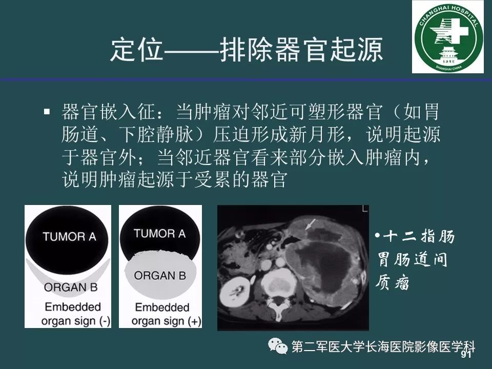 影像PPT - 【PPT】常见的腹膜后占位诊断及鉴别诊断-90