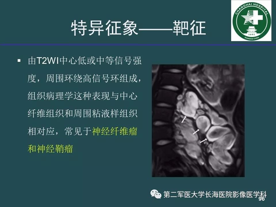 影像PPT - 【PPT】常见的腹膜后占位诊断及鉴别诊断-95