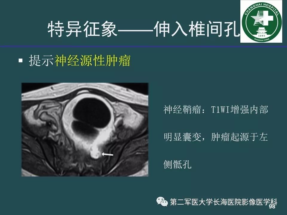 影像PPT - 【PPT】常见的腹膜后占位诊断及鉴别诊断-97