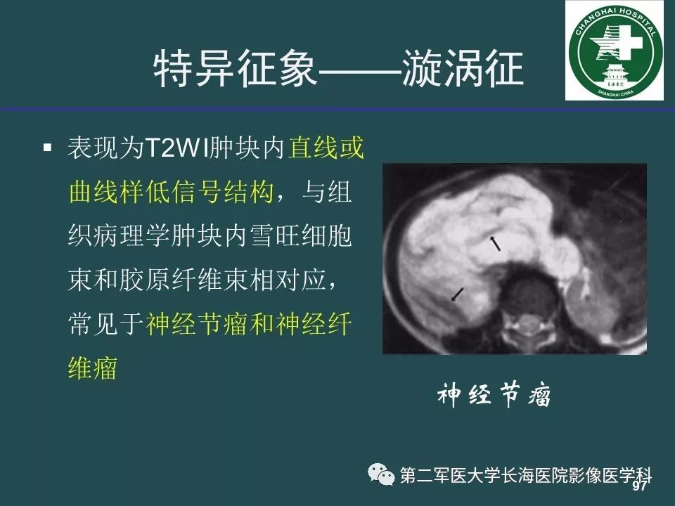 影像PPT - 【PPT】常见的腹膜后占位诊断及鉴别诊断-96