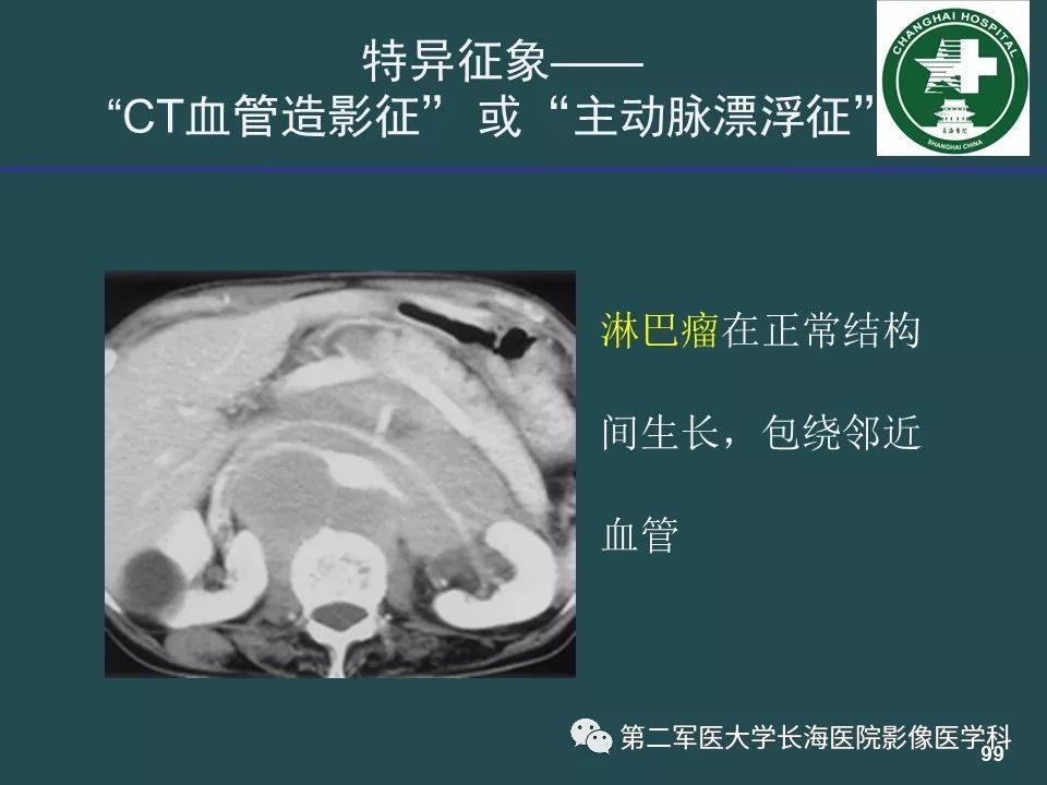 影像PPT - 【PPT】常见的腹膜后占位诊断及鉴别诊断-98