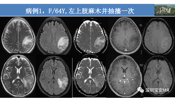 影像PPT - 【PPT】淀粉样脑血管病的影像诊断-1