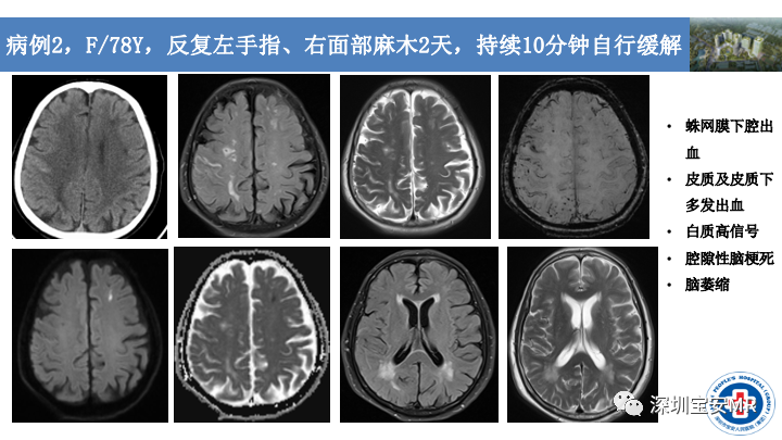 影像PPT - 【PPT】淀粉样脑血管病的影像诊断-2