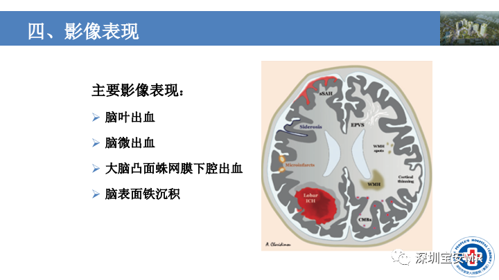 影像PPT - 【PPT】淀粉样脑血管病的影像诊断-11