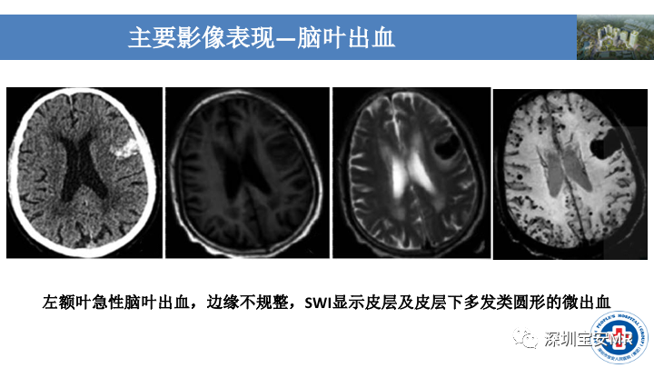 影像PPT - 【PPT】淀粉样脑血管病的影像诊断-12