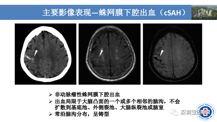 影像PPT - 【PPT】淀粉样脑血管病的影像诊断-15