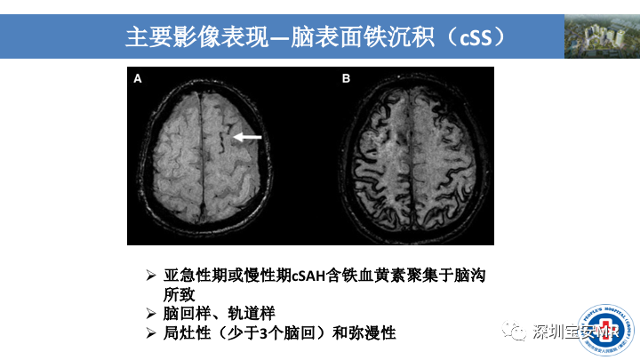 影像PPT - 【PPT】淀粉样脑血管病的影像诊断-16