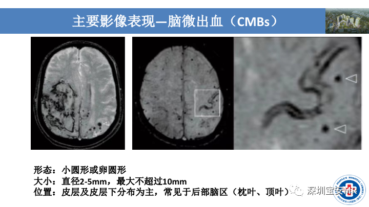 影像PPT - 【PPT】淀粉样脑血管病的影像诊断-14