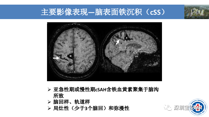 影像PPT - 【PPT】淀粉样脑血管病的影像诊断-17