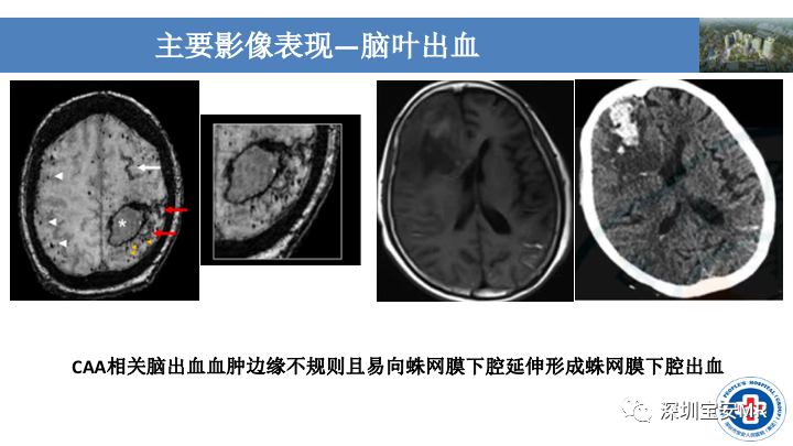 影像PPT - 【PPT】淀粉样脑血管病的影像诊断-13
