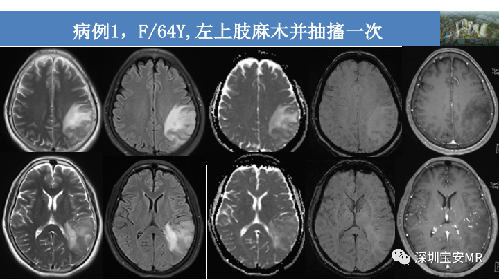 影像PPT - 【PPT】淀粉样脑血管病的影像诊断-18