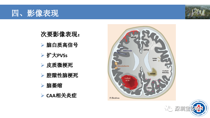 影像PPT - 【PPT】淀粉样脑血管病的影像诊断-21