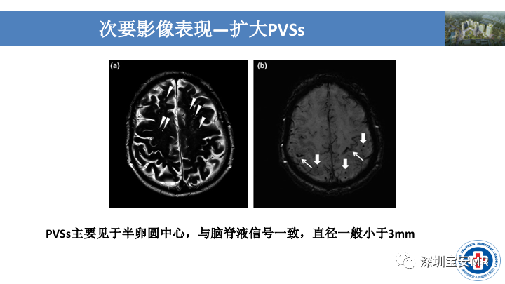 影像PPT - 【PPT】淀粉样脑血管病的影像诊断-23