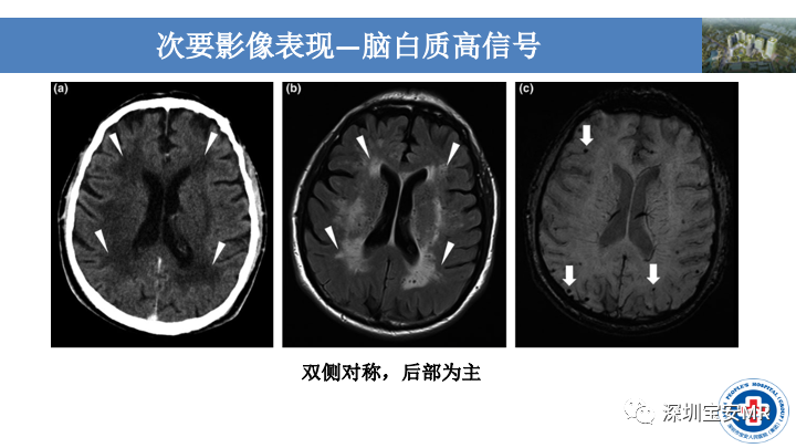 影像PPT - 【PPT】淀粉样脑血管病的影像诊断-22