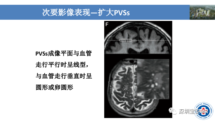 影像PPT - 【PPT】淀粉样脑血管病的影像诊断-24