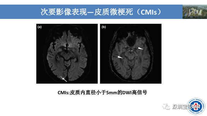 影像PPT - 【PPT】淀粉样脑血管病的影像诊断-25