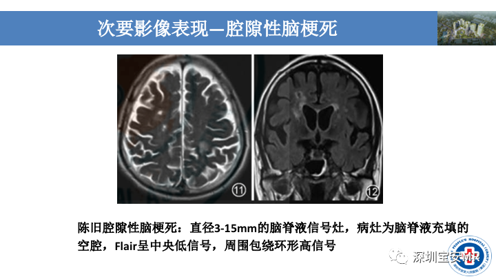 影像PPT - 【PPT】淀粉样脑血管病的影像诊断-26