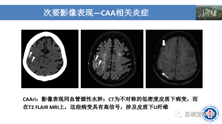 影像PPT - 【PPT】淀粉样脑血管病的影像诊断-28