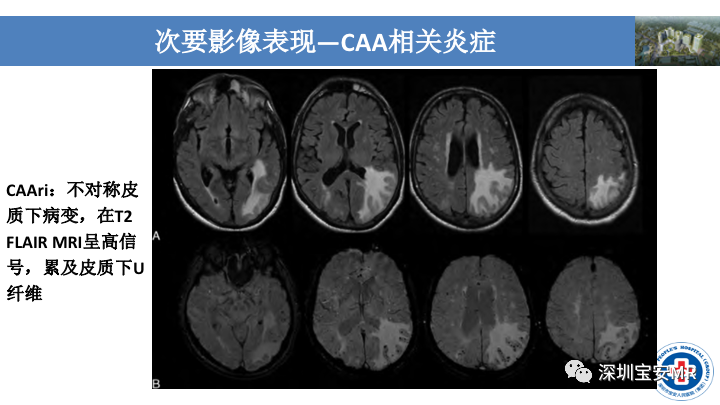 影像PPT - 【PPT】淀粉样脑血管病的影像诊断-29