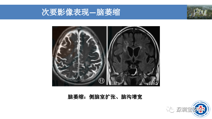 影像PPT - 【PPT】淀粉样脑血管病的影像诊断-27
