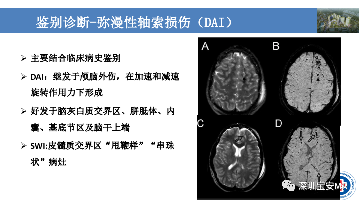影像PPT - 【PPT】淀粉样脑血管病的影像诊断-31