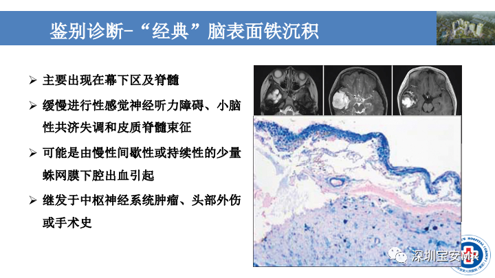 影像PPT - 【PPT】淀粉样脑血管病的影像诊断-32