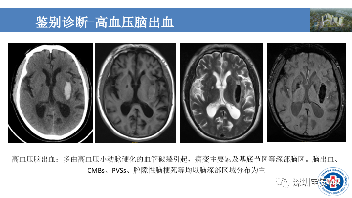 影像PPT - 【PPT】淀粉样脑血管病的影像诊断-33