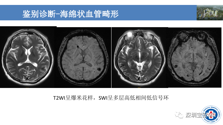 影像PPT - 【PPT】淀粉样脑血管病的影像诊断-34