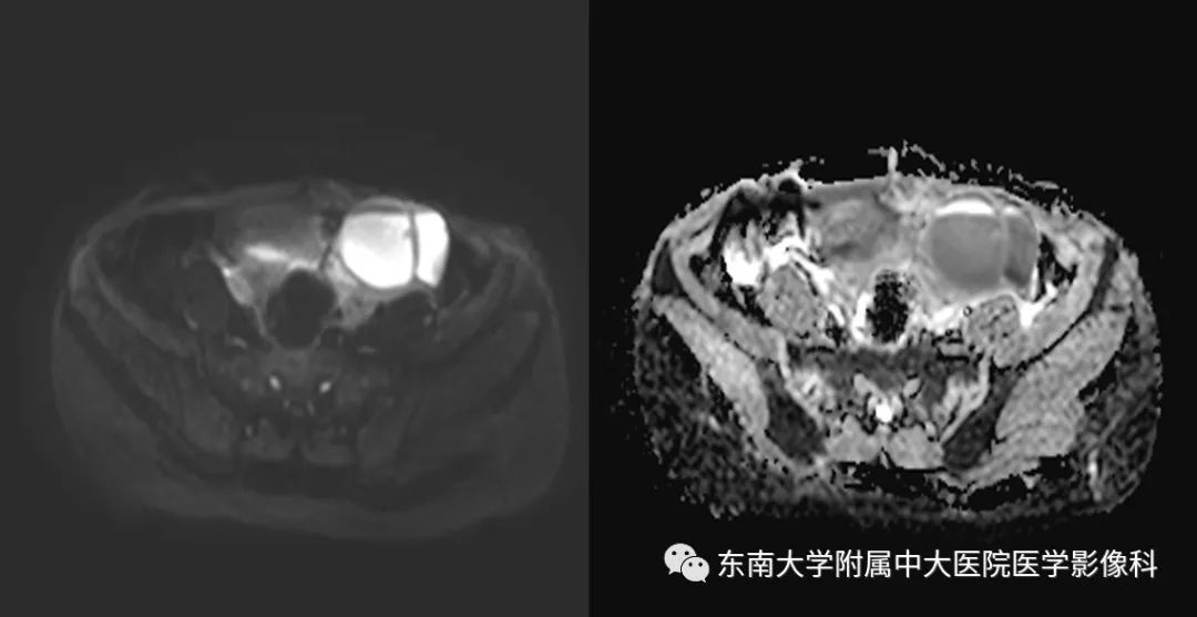 影像PPT - 【PPT】输卵管积脓-2