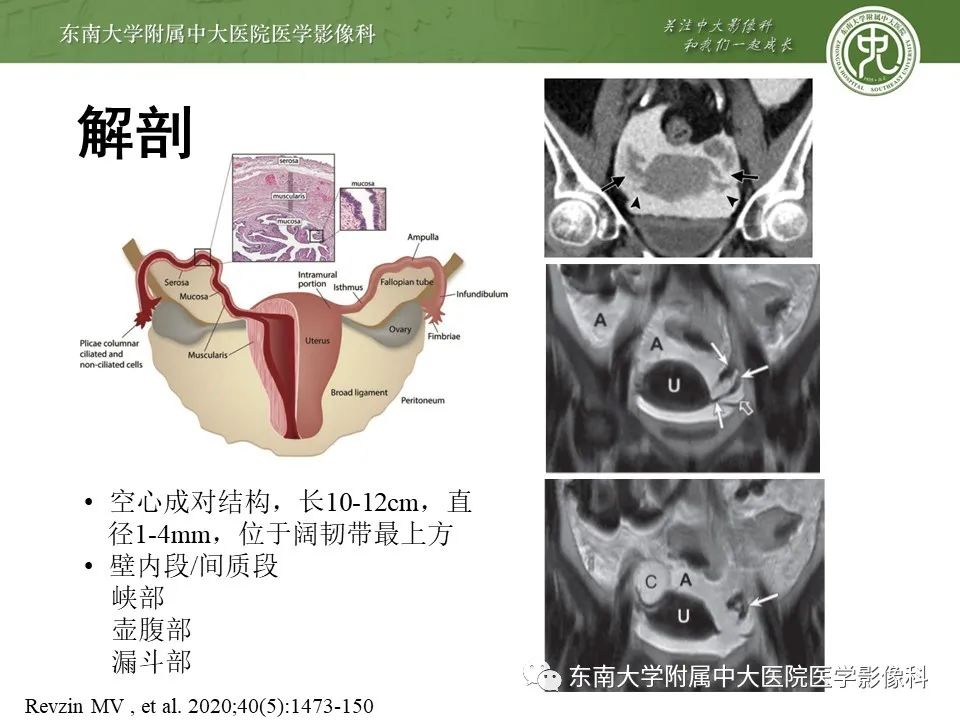 影像PPT - 【PPT】输卵管积脓-5