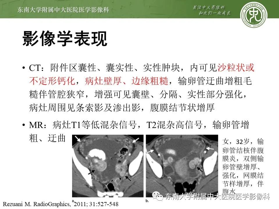 影像PPT - 【PPT】输卵管积脓-13