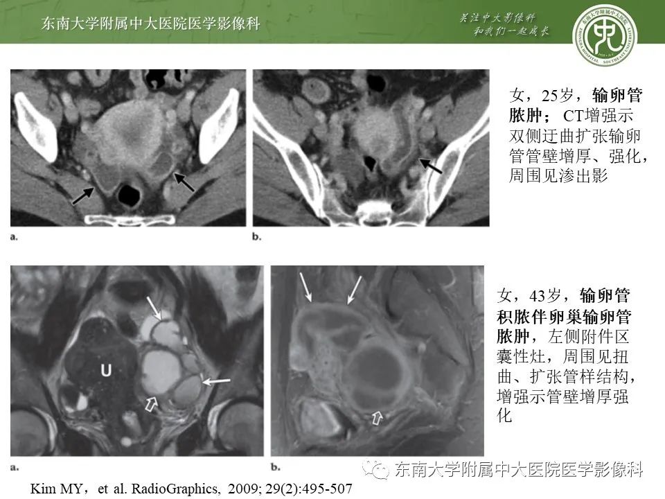 影像PPT - 【PPT】输卵管积脓-10