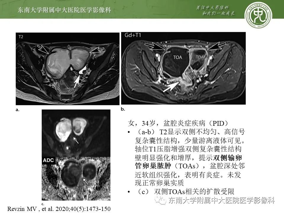 影像PPT - 【PPT】输卵管积脓-11